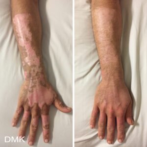 11293144MyDMKBrandedBeforeandAfterImageryDMKBetaGel1300dpi