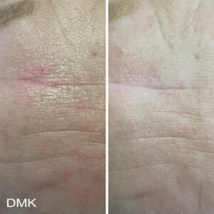 1389616862MyDMKBrandedBeforeandAfterImageryScarring3300dpi