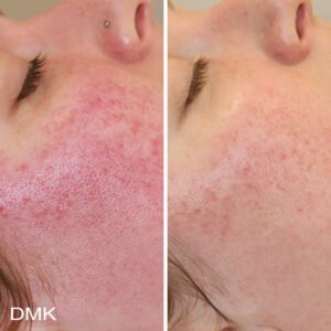 1421256580MyDMKBrandedBeforeandAfterImageryReactiveSkin3300dpi