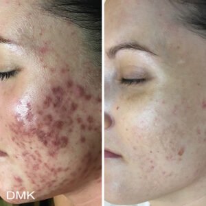 165579878MyDMKBrandedBeforeandAfterImageryScarring2300dpi