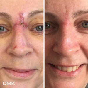 1678377921MyDMKBrandedBeforeandAfterImageryScarring1300dpi