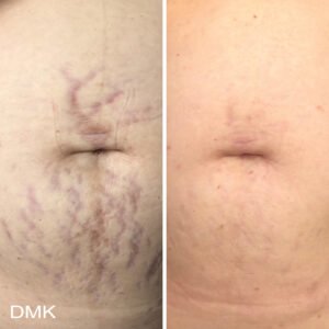 1789816303MyDMKBrandedBeforeandAfterImageryScarring11300dpi