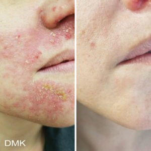 2013199434MyDMKBrandedBeforeandAfterImageryReactiveSkin5300dpi