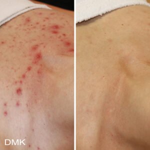 652514235MyDMKBrandedBeforeandAfterImageryScarring5300dpi