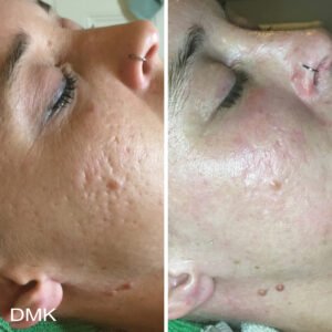 78220075MyDMKBrandedBeforeandAfterImageryScarring10300dpi