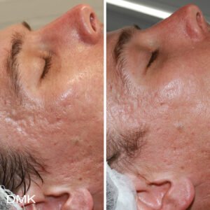 94132233MyDMKBrandedBeforeandAfterImageryScarring6300dpi